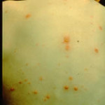 chickenpox