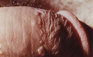 Human Pap Wart