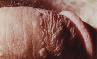 hpv male genital warts)