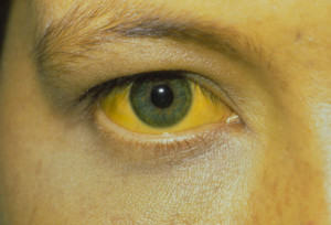 yellow-eyes-and-skin_1