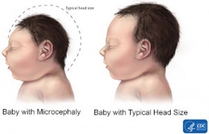 zika-microcephaly-300x193